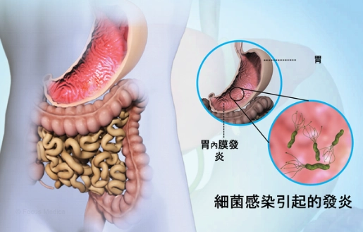 胃炎飲食