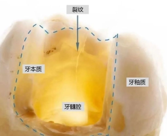 酸味敏感 酸味敏感