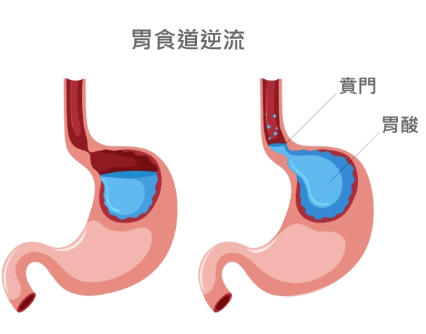 胃酸逆流營養建議