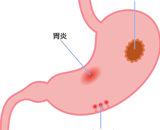 胃潰瘍飲食禁忌