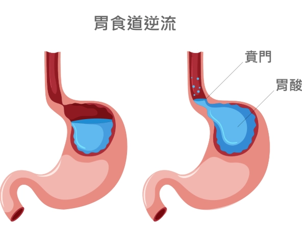 孕婦胃酸逆流緩解