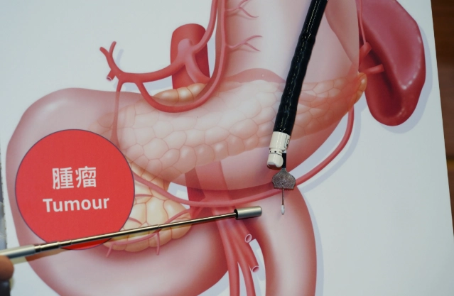 胃脹氣快速解決 胃脹氣快速解決