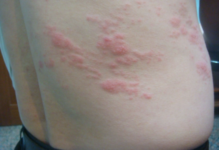 帶狀皰疹海鮮禁忌 帶狀皰疹海鮮禁忌