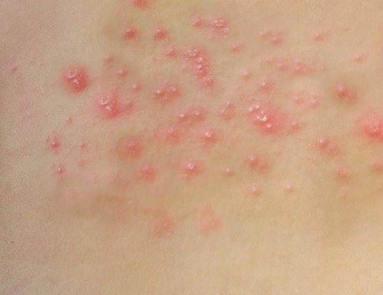 帶狀皰疹可以吃什麼