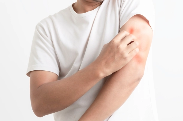 濕疹飲食禁忌水果