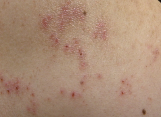 帶狀皰疹可以吃什麼