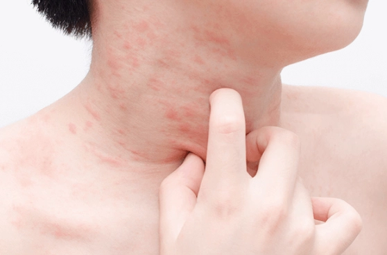 敏感肌膚吃什麼