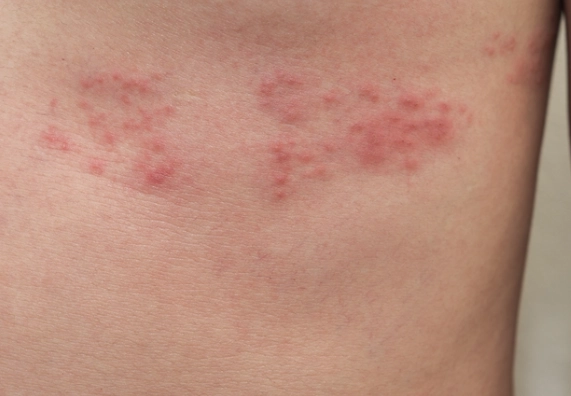 帶狀皰疹飲食 帶狀皰疹飲食