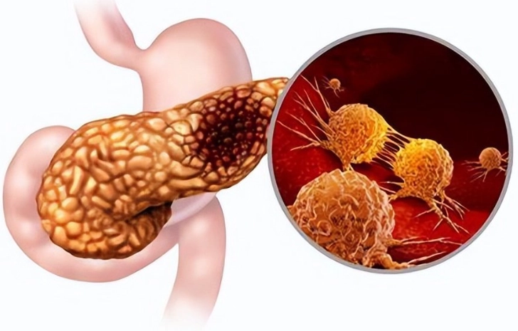 急性胰臟炎治療