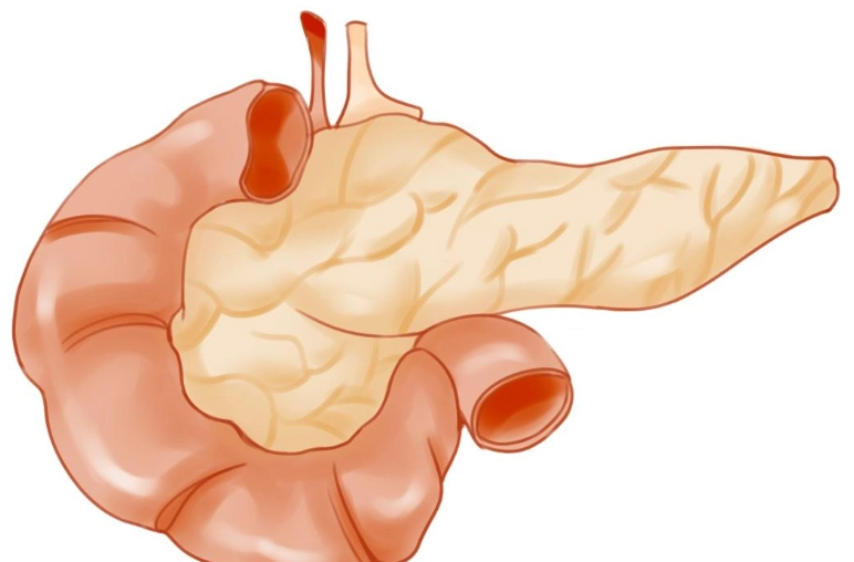 急性胰臟炎 死亡率
