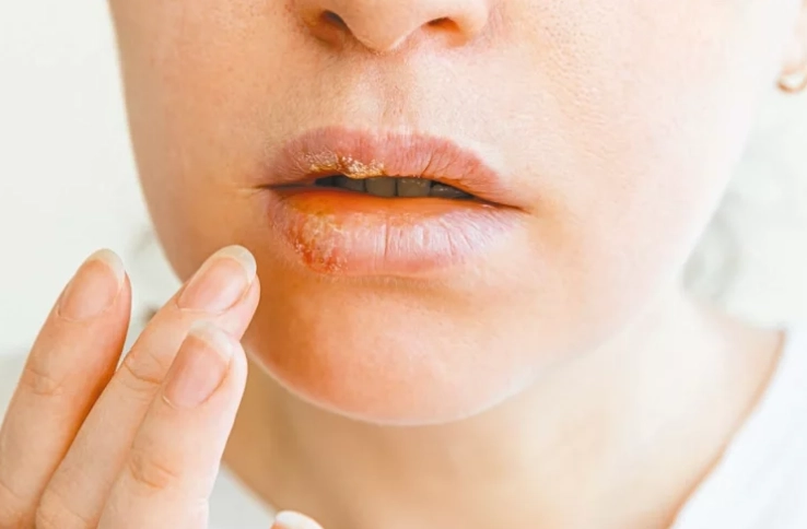 唇皰疹治療 唇皰疹治療