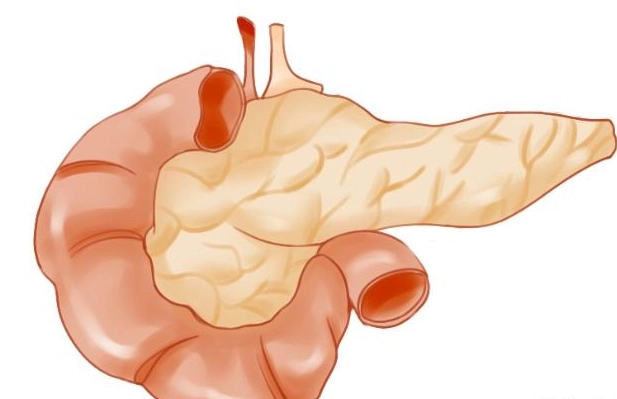 急性胰臟炎治療