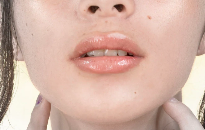 嬰兒唇皰疹 嬰兒唇皰疹