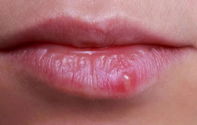 唇皰疹治療 唇皰疹治療