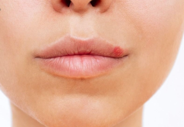 唇皰疹結痂擦藥