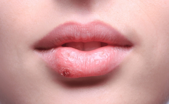唇皰疹初期圖片 唇皰疹初期圖片