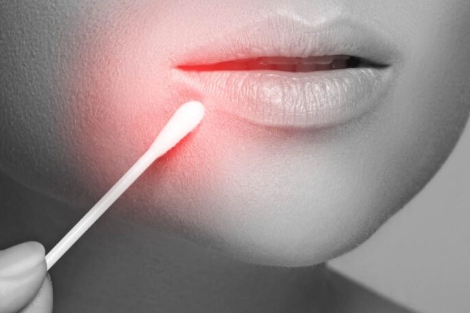 唇皰疹初期治療 唇皰疹初期治療
