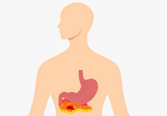 急性胰臟炎治療
