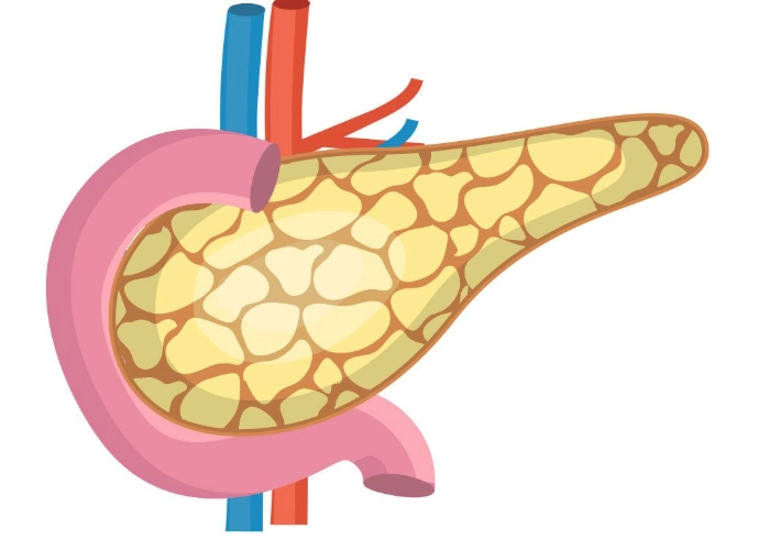 胰臟炎 高血糖 飲食 胰臟炎 高血糖 飲食