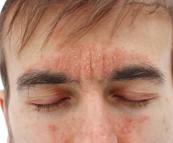 皮膚敏感食療全攻略：飲食調整改善肌膚問題的關鍵步驟