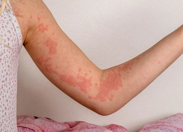 蕁麻疹 飲食 蕁麻疹 飲食