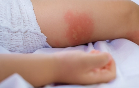 蕁麻疹 可以吃什麼 蕁麻疹 可以吃什麼