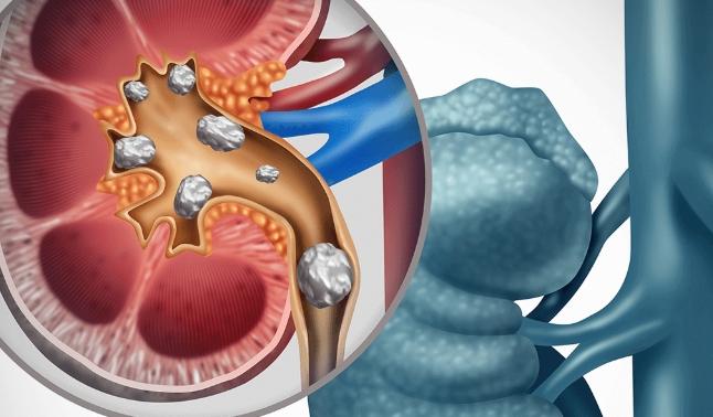 腎結石可以喝檸檬水嗎