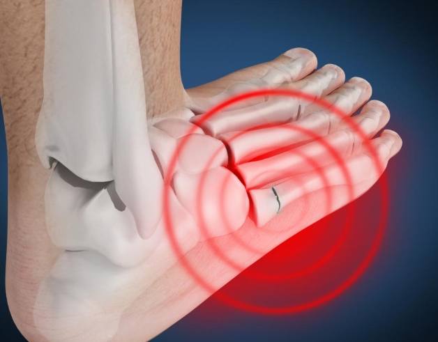 骨折飲食禁忌 骨折飲食禁忌