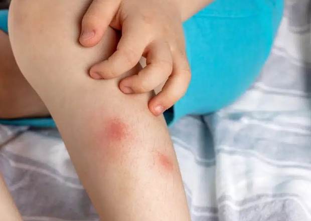 床蝨傷口處理 床蝨傷口處理