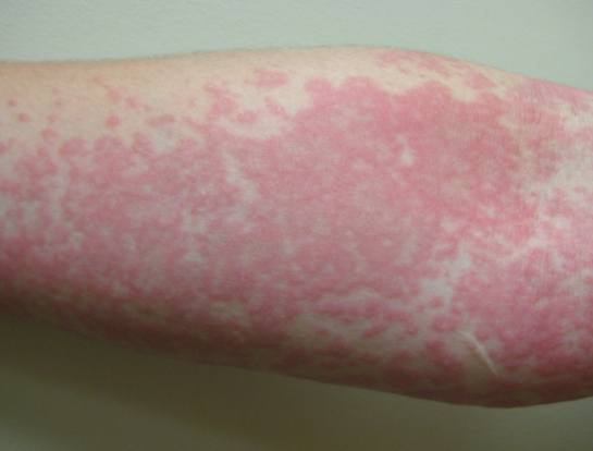 豆腐過敏反應 豆腐過敏反應