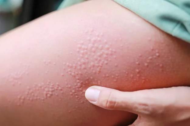 濕疹飲食禁忌 濕疹飲食禁忌