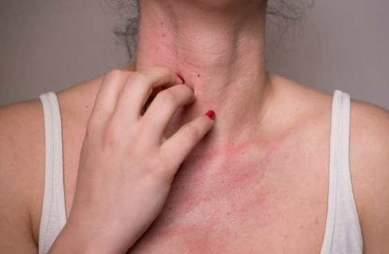 奇異果副作用 奇異果副作用