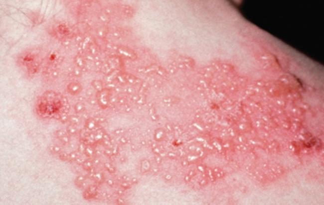 泡狀病毒症狀 泡狀病毒症狀