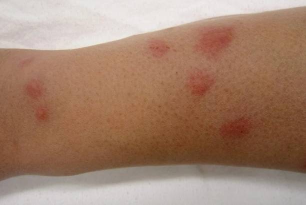 床虱咬傷症狀 床虱咬傷症狀