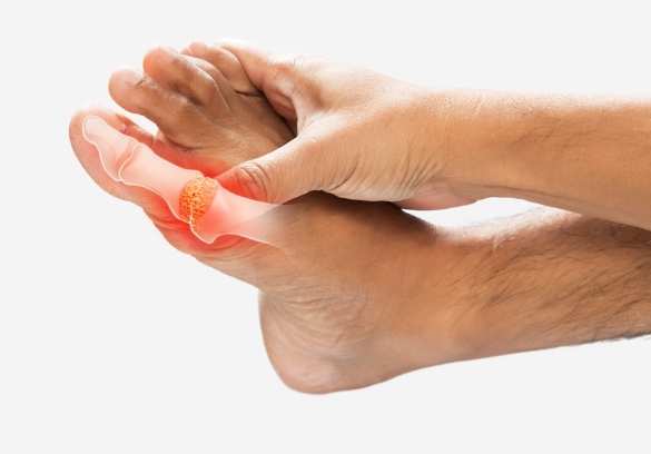 痛風 西蘭花 痛風 西蘭花