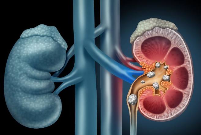 檸檬水 腎結石 好處