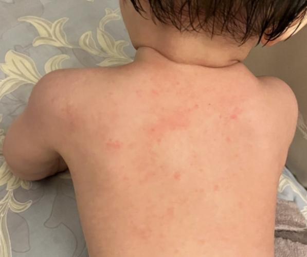 皮膚過敏食物清單 皮膚過敏食物清單