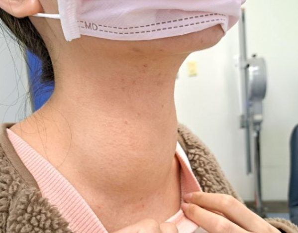 甲狀腺亢進不能吃的食物