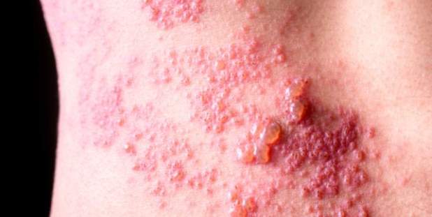 泡狀病毒防治 泡狀病毒防治