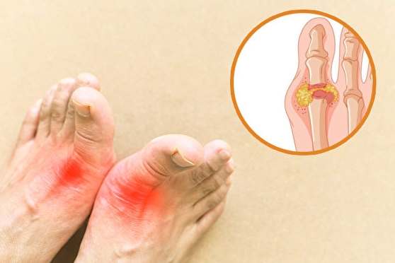 尿酸過高症狀 尿酸過高症狀