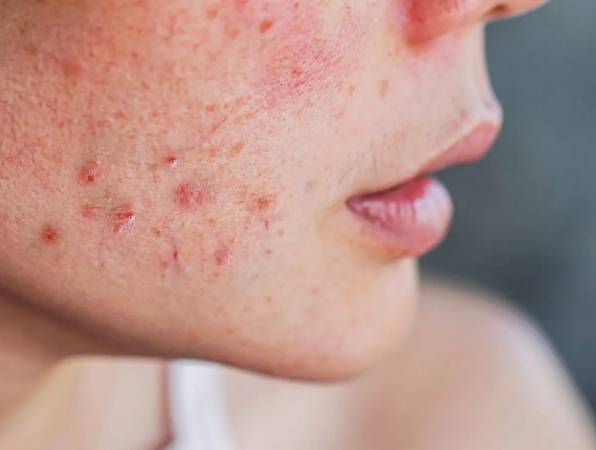 過敏不能吃的水果 過敏不能吃的水果