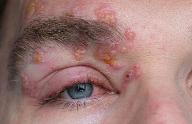 泡狀病毒防治 泡狀病毒防治