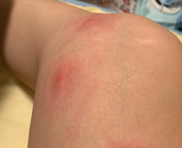 床虱咬傷症狀 床虱咬傷症狀