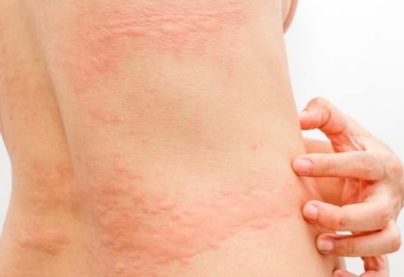 皮膚過敏水果禁忌 皮膚過敏水果禁忌