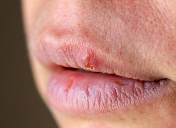 唇皰疹結痂護理