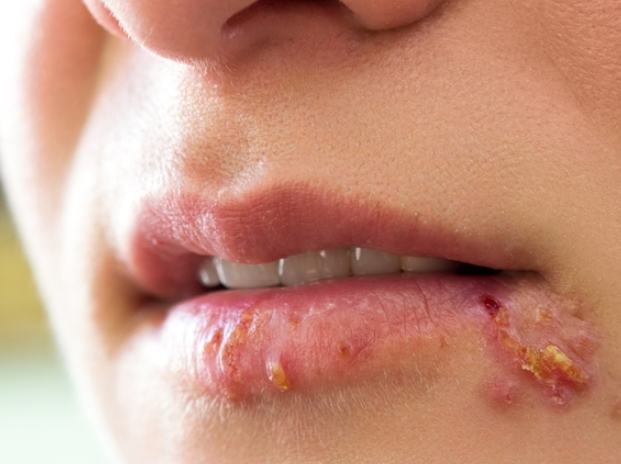 泡狀病毒症狀 泡狀病毒症狀