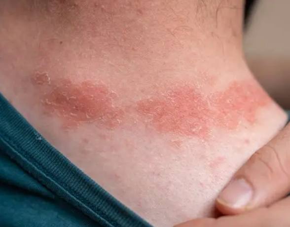 濕疹水果地雷 濕疹水果地雷