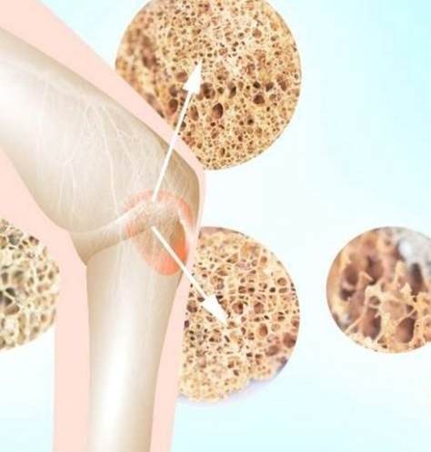 骨質疏鬆治療 骨質疏鬆治療