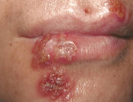 唇皰疹結痂期