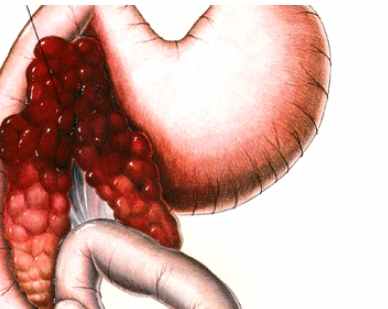 胰臟壞死症狀 胰臟壞死症狀